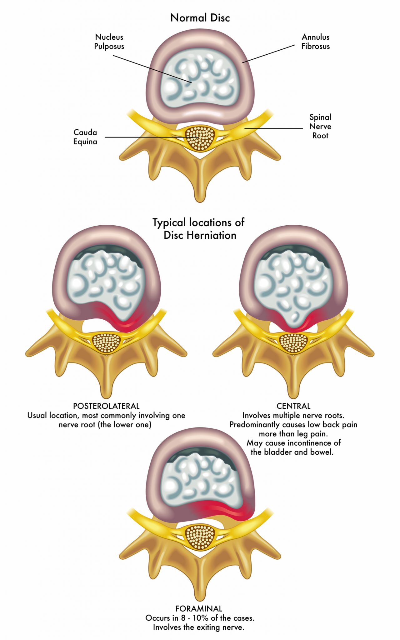 Slipped Disc: Which Treatment? | Integrated Chiropractic & Acupuncture