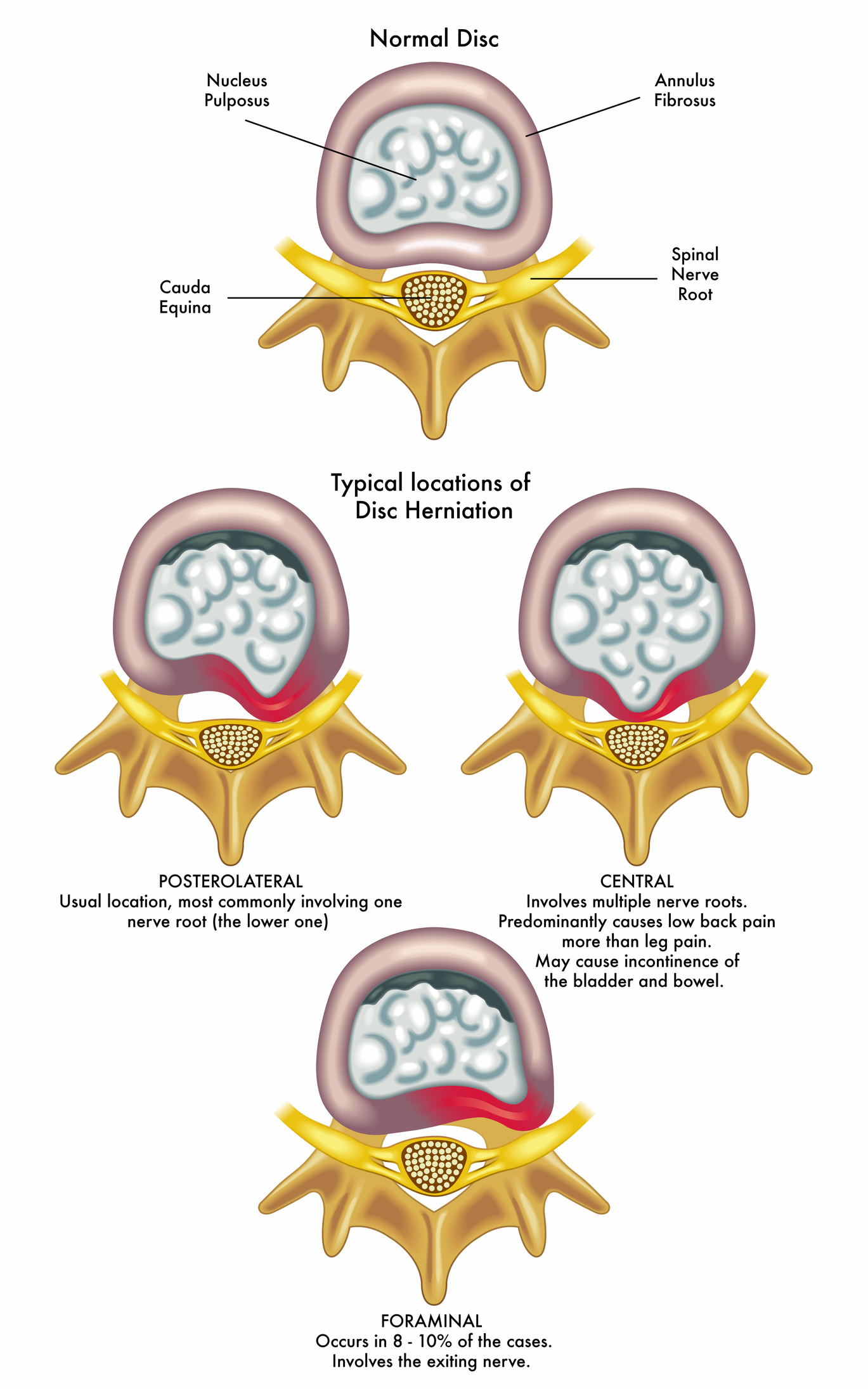 slipped-disc-which-treatment-integrated-chiropractic-acupuncture